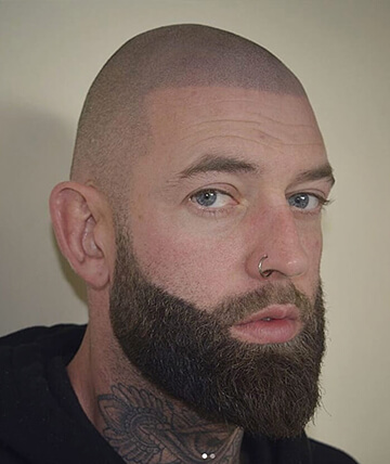 scalp micropigmentation after picture