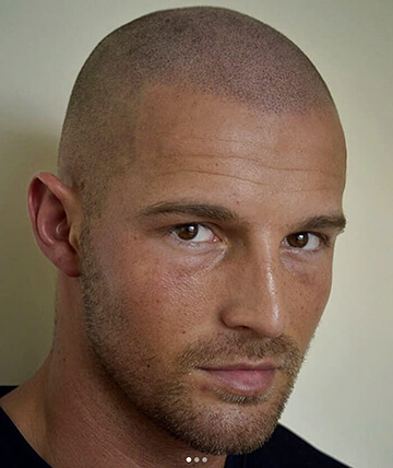 scalp micropigmentation after picture