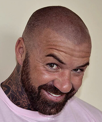 scalp micropigmentation after picture