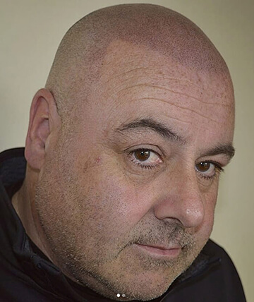 scalp micropigmentation after picture