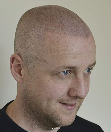 scalp micropigmentation after picture