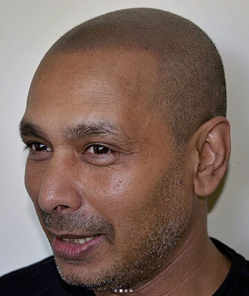 scalp micropigmentation after picture