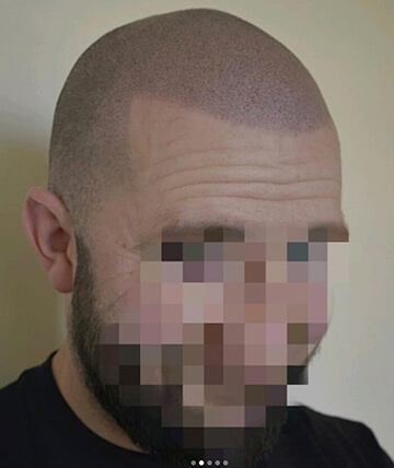 scalp micropigmentation after picture
