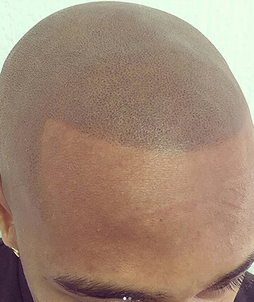 scalp micropigmentation after picture