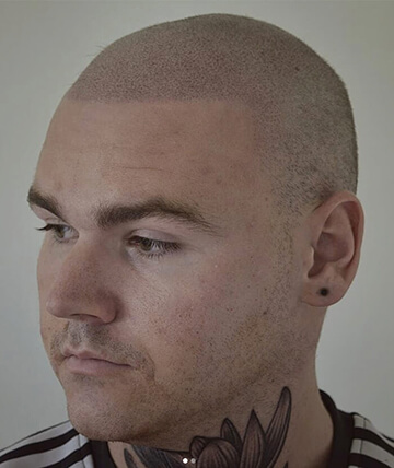 scalp micropigmentation after picture