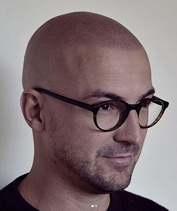 scalp micropigmentation after picture