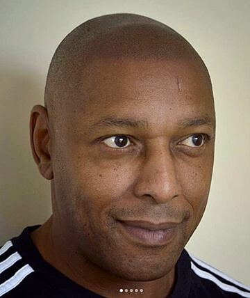 scalp micropigmentation after picture