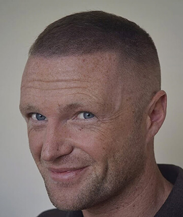 scalp micropigmentation after picture