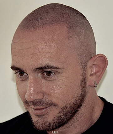 scalp micropigmentation after picture