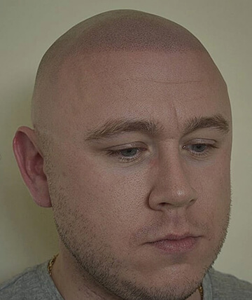 scalp micropigmentation after picture