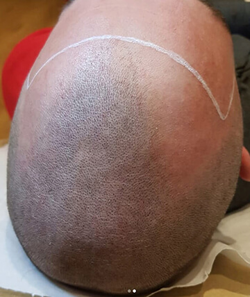 scalp micropigmentation before picture