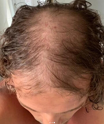 scalp micropigmentation before picture