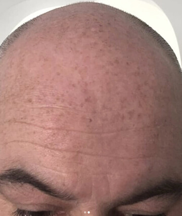 scalp micropigmentation before picture