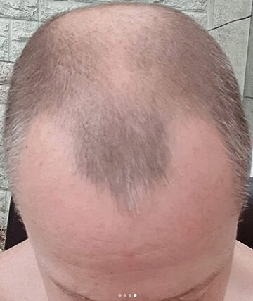 scalp micropigmentation before picture
