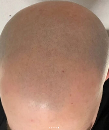 scalp micropigmentation before picture