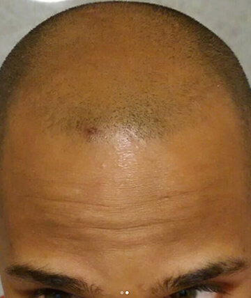 scalp micropigmentation before picture