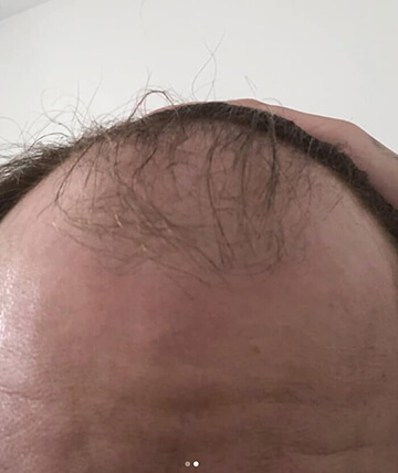 scalp micropigmentation before picture