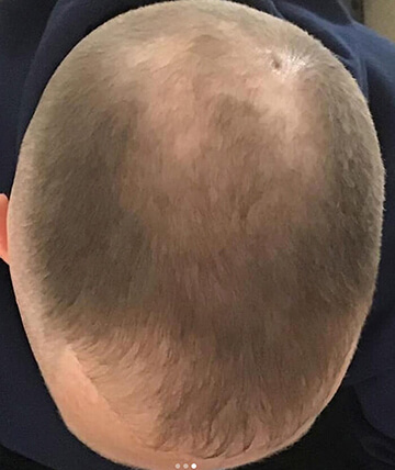 scalp micropigmentation before picture