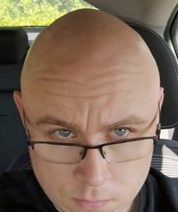 scalp micropigmentation before picture