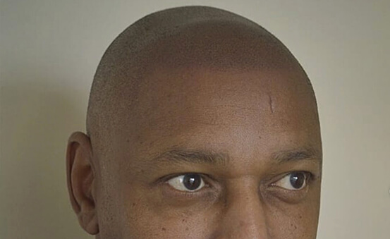 smp for Receding Hair