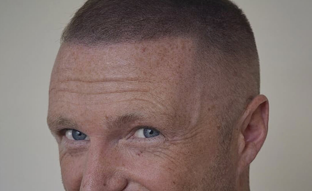 smp for thinning hair